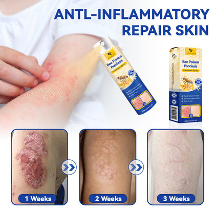 【Official Brand Store】PsoriaHeal Psoriasis Spray Pro